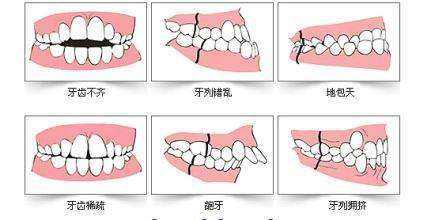 这10类牙齿畸形都能矫正