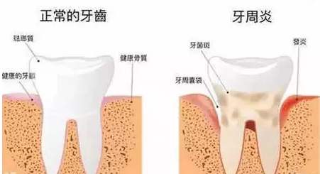 牙周炎的治疗分为几个阶段