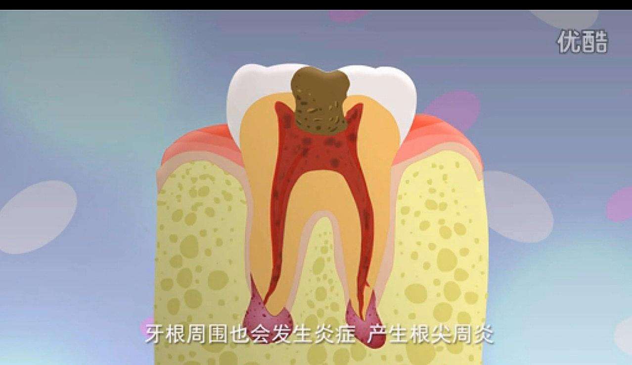 导致牙髓炎的病因都有哪些