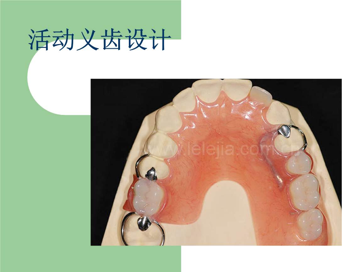 可摘局部义齿有哪些不稳定因素