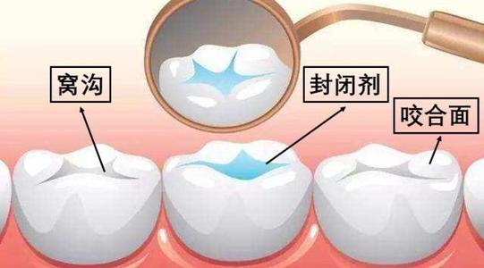 为什么要做窝沟封闭？