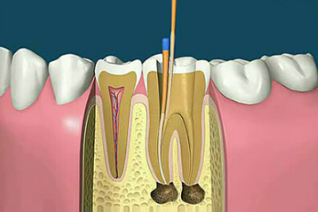 为什么要做根管治疗