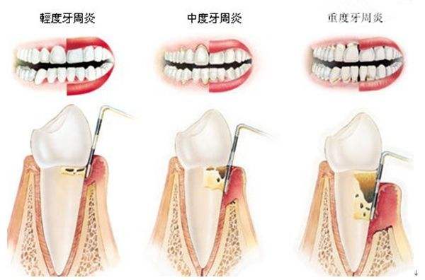 牙周病的治疗