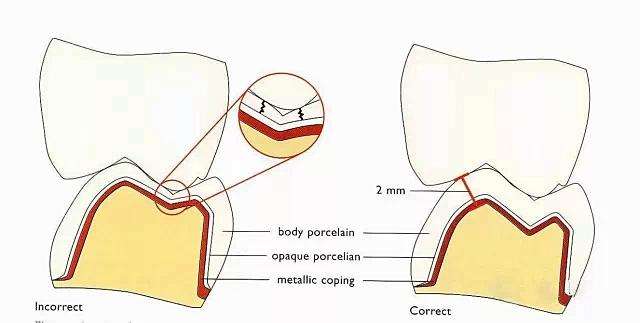 瓷全冠需要注意哪些事项
