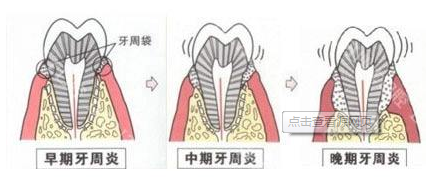 牙周病能不能根治?