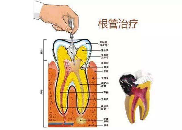 牙齿在根管治疗中为什么会疼痛呢?