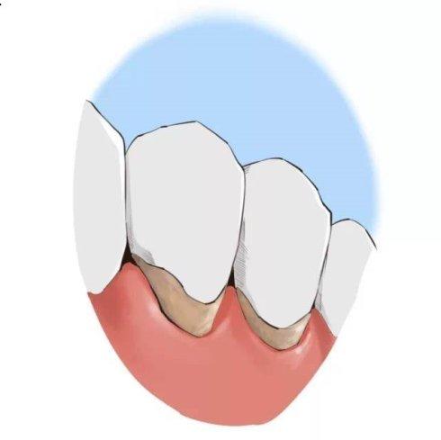 什么情况下会造成牙龈萎缩？没有牙周病也会牙