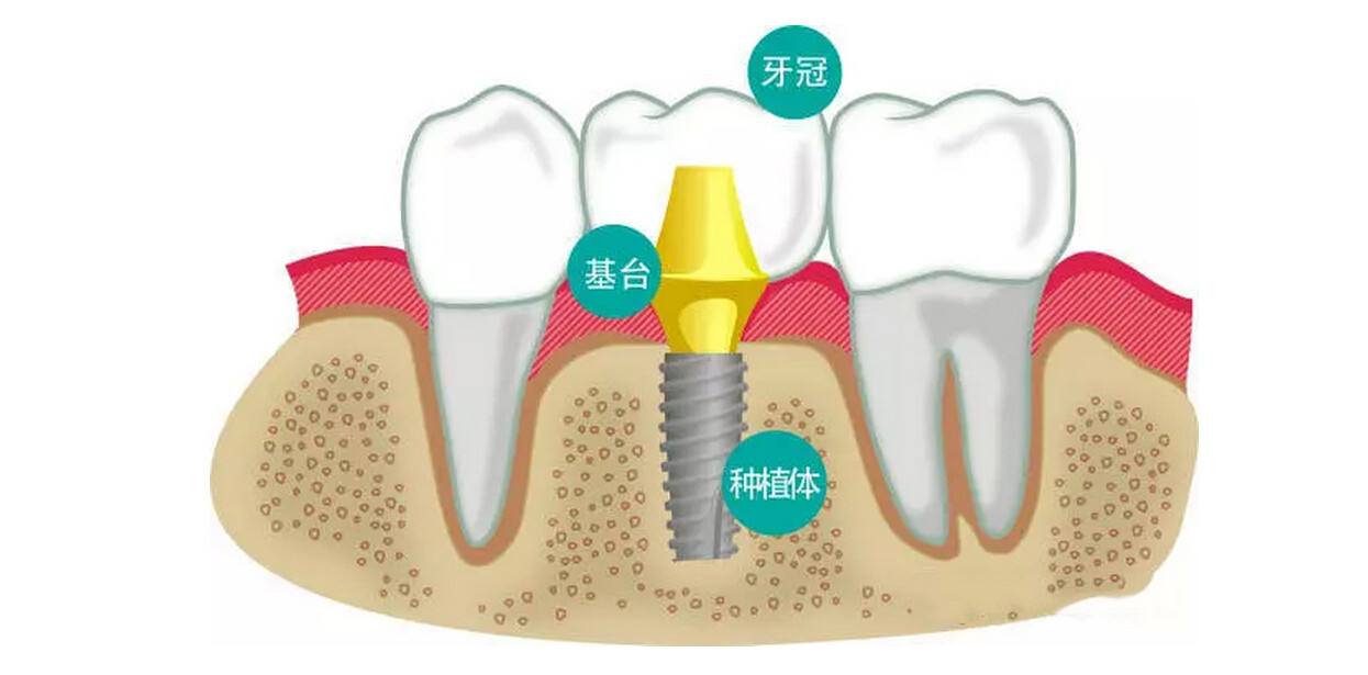 种植牙的优点是什么
