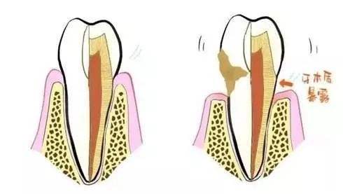 牙周病患者要怎么选择牙间刷？