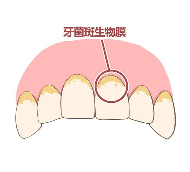 牙菌斑的生物膜分类