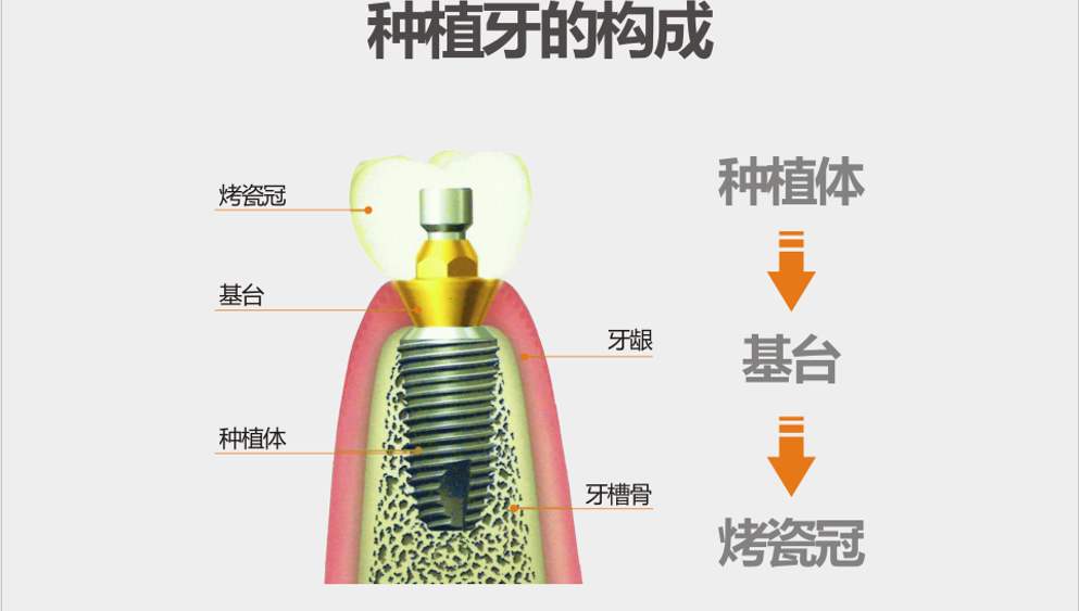 如何提升种植牙的成功率