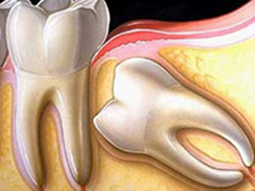 什么是阻生性智齿？