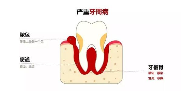 牙龈萎缩就表示我有牙周病？