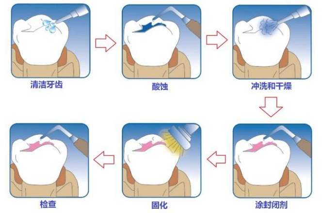 牙体粘结修复术的优势是什么