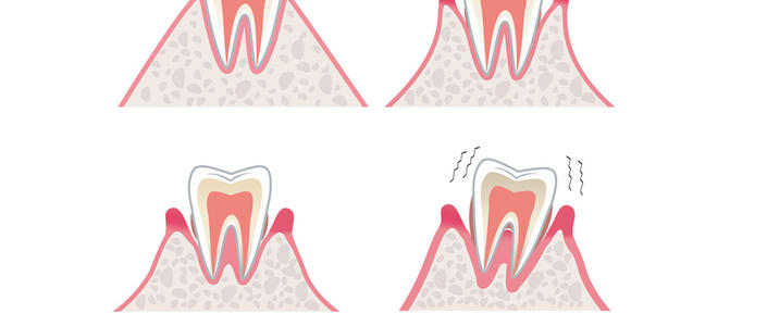 牙周组织分为哪几类