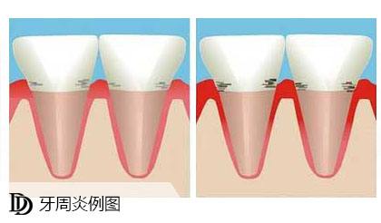 牙周病治疗的方式有哪几种？