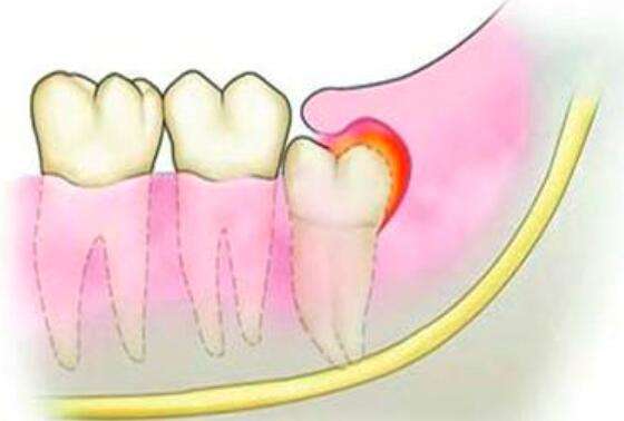 鉴别智齿冠周炎的方法