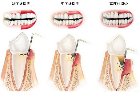 常见牙周炎分类