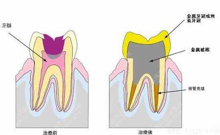 慢性牙髓炎治疗方案的介绍