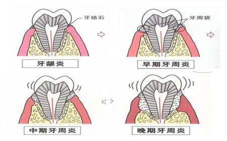 牙周组织病主要分为哪几类