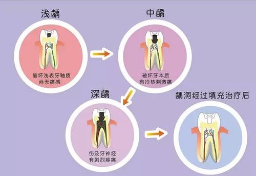 龋病的龋坏程度