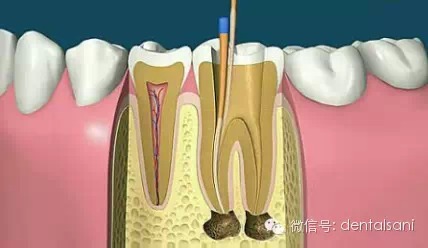 牙髓增龄的变化