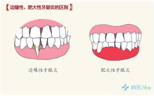 其他原因引起的牙龈炎