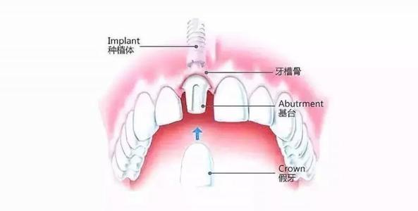 何为人工种植牙