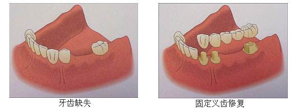 固定义齿修复有哪些特点