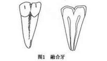 融合牙的治疗方法有什么？