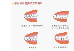 牙齿排列不齐的危害