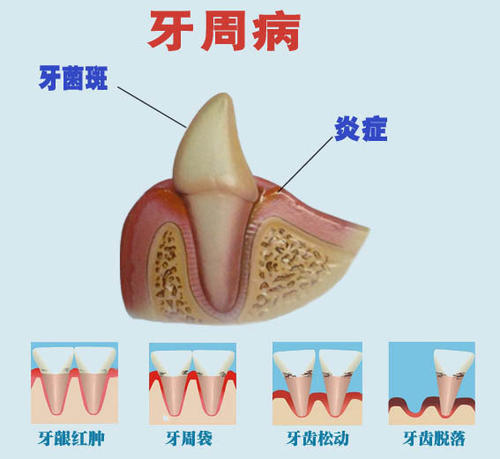 如何有效预防牙周病