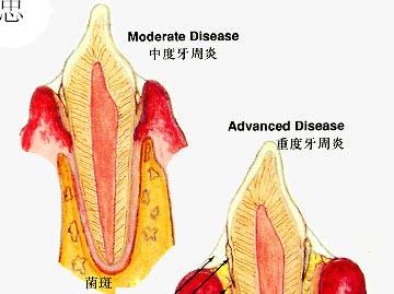 牙周病的自查办法