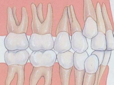 牙列拥挤的临床表现