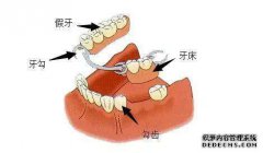 不良修复体对牙齿的危害