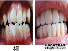 烤瓷牙有哪些分类？