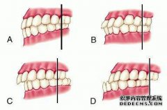 牙齿咬合不齐有什么影响？