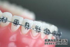 修复门牙牙缝要多少钱？