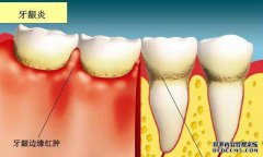 治疗牙龈出血的有效方法