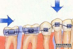 牙齿矫正的费用是多少？