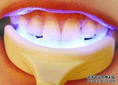 牙齿冷光美白副作用有哪些？