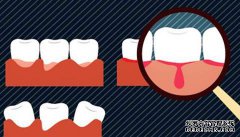 为什么牙龈会出血？