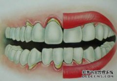 牙周病的有效治疗措施有哪些？