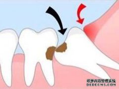 有牙周炎症要如何控制？