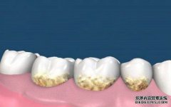 牙周病有哪些危害？