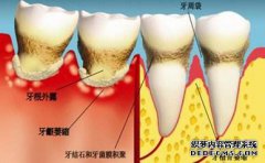 牙周病到底是如何形成的？