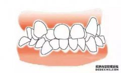 造成牙齿拥挤的原因是什么？