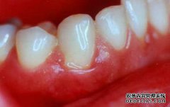 为什么牙龈老是肿痛呢？