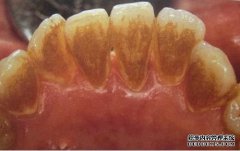 牙结石要如何治疗？