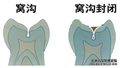 儿童窝沟封闭是怎么一回事儿？